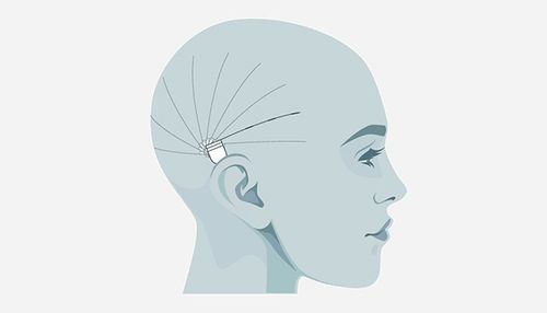 UNEEG_medical_subcutaneous-eeg.jpg